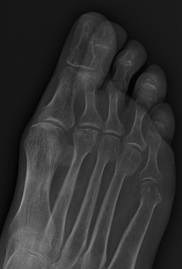 Antero-posterior forefoot in Freiberg disease: the 2nd metatarsal head is flattened, broadened and sclerotic compared with the rounded neighbouring heads. (James Heilman MD, Wikimedia Commons; CC BY-SA 4.0.)