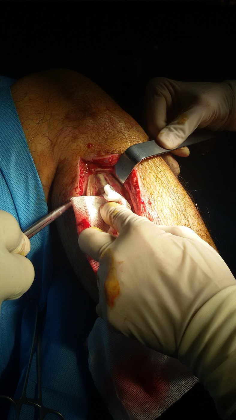 Figure 19. Intra-operative fasciotomy of the leg for compartment syndrome, decompressing a fascial compartment through a long longitudinal incision. آرمین, CC0, via Wikimedia Commons.
