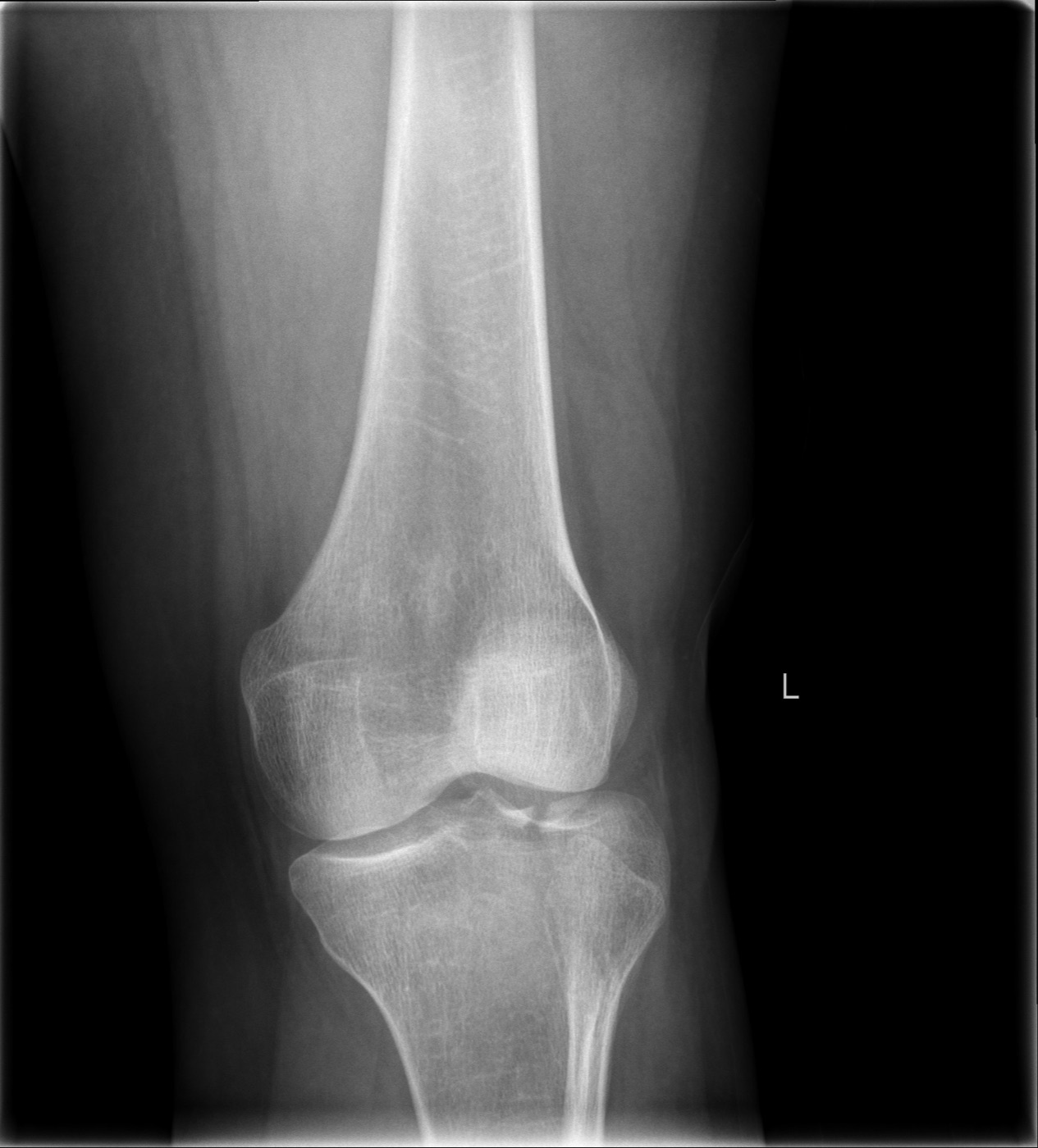 Figure 15. Anteroposterior radiograph of a lateral tibial plateau fracture with articular depression (a Schatzker-pattern injury). LottieLattes, CC BY-SA 4.0, via Wikimedia Commons.