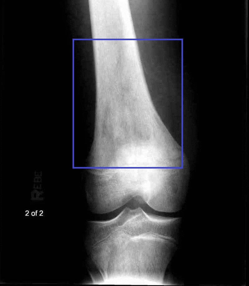 Figure 1. Conventional osteosarcoma - aggressive mixed lytic-sclerotic lesion of the distal femoral metaphysis. Dulebohn & Bhimji, CC BY 4.0, Wikimedia Commons.