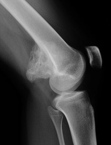 Figure 4. Parosteal osteosarcoma - dense, broad-based ossified mass on the posterior distal-femoral cortex. Papathanassiou et al., Clin Sarcoma Res 2011, CC BY, via PMC.