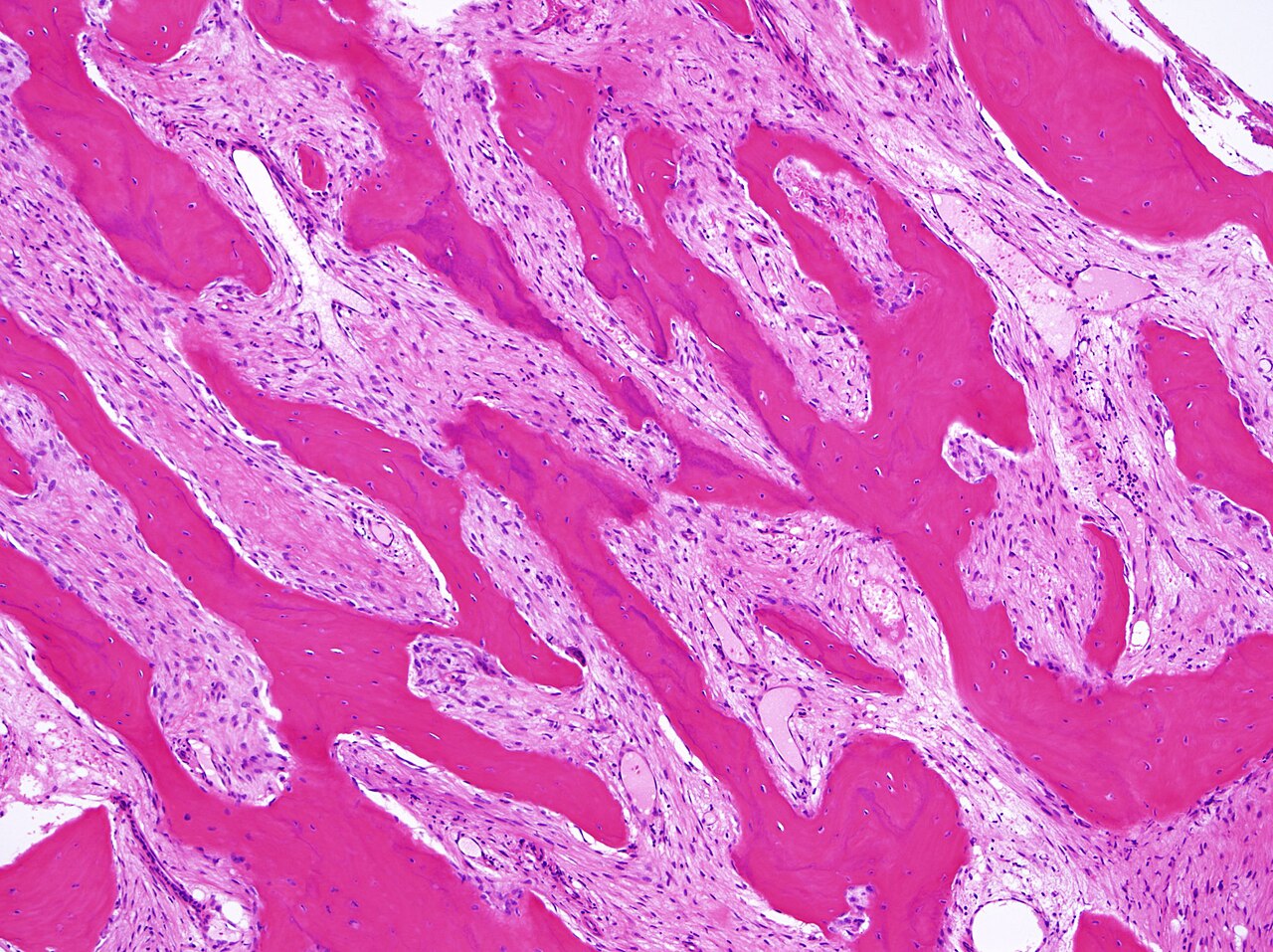 Figure 5. Parosteal osteosarcoma - parallel woven-bone trabeculae in a bland spindle-cell stroma (H&E). T. Fujisawa, CC BY-SA 4.0, Wikimedia Commons.