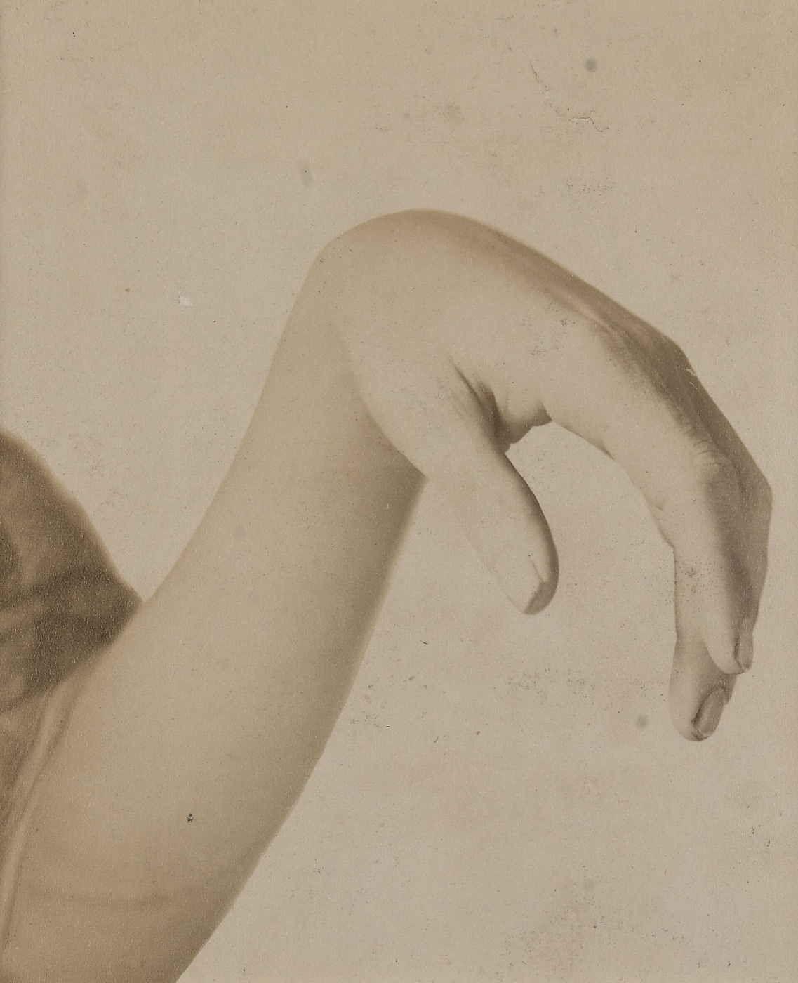 Figure 9. Wrist drop of a complete (high) radial nerve palsy. In PIN syndrome, by contrast, wrist extension is preserved (deviating radially) because the radial wrist extensors are spared. Source: Wellcome Collection, via Wikimedia Commons, CC BY 4.0.