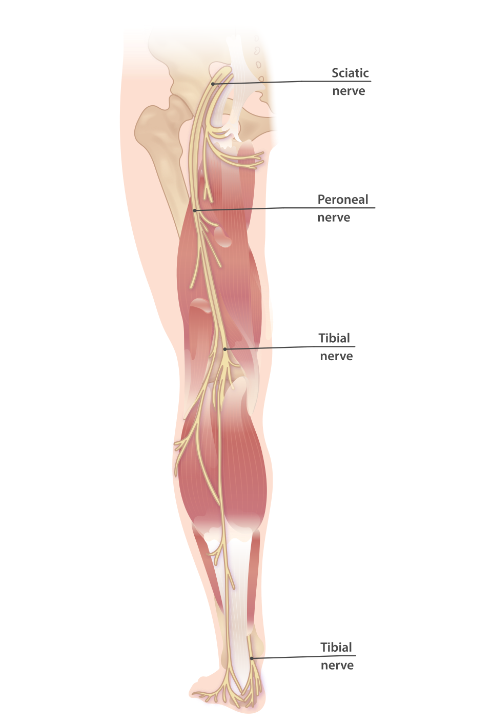 Figure 13. The sciatic nerve dividing into the tibial and common peroneal (fibular) nerves; the common peroneal is vulnerable as it crosses the fibular neck. Source: InjuryMap, via Wikimedia Commons, CC BY-SA 4.0.