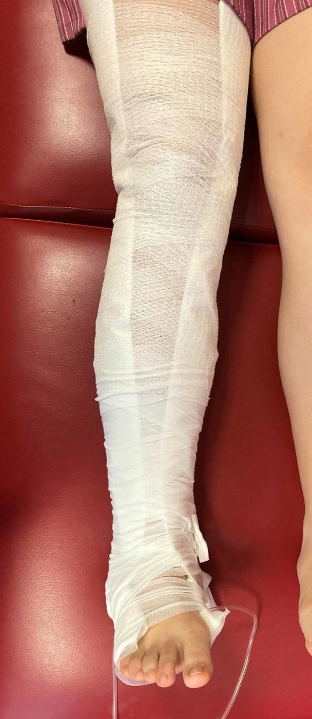 Figure 7. Skin (Buck’s-type) traction applied to the leg with felt and a crepe bandage - a light-load, temporary measure. From Mc Carthy et al. (2020), PMC7100621, CC BY 4.0.