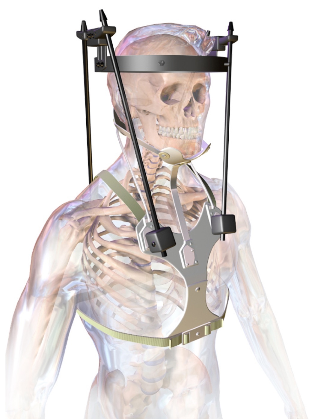 Figure 10. Halo vest for cervical-spine traction and immobilisation - skull pins fixed to a rigid vest by anterior and posterior rods. Source: BruceBlaus, via Wikimedia Commons, CC BY-SA 4.0.