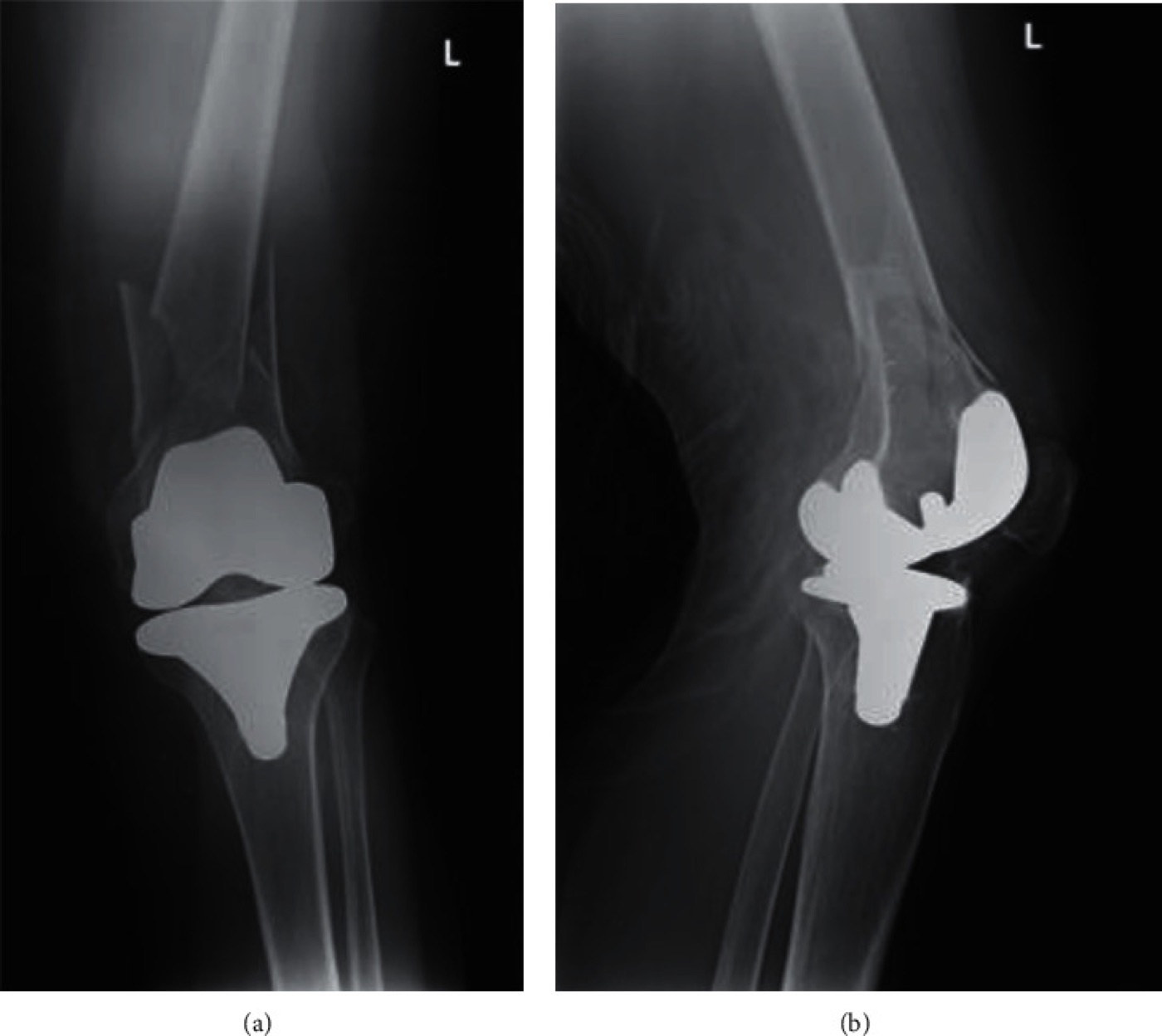 Figure 14. A comminuted periprosthetic distal-femoral fracture above a total knee replacement (Lewis-Rorabeck type II). From Moukarzel et al. (2021), Case Reports in Orthopedics, PMC8612792, CC BY 4.0.