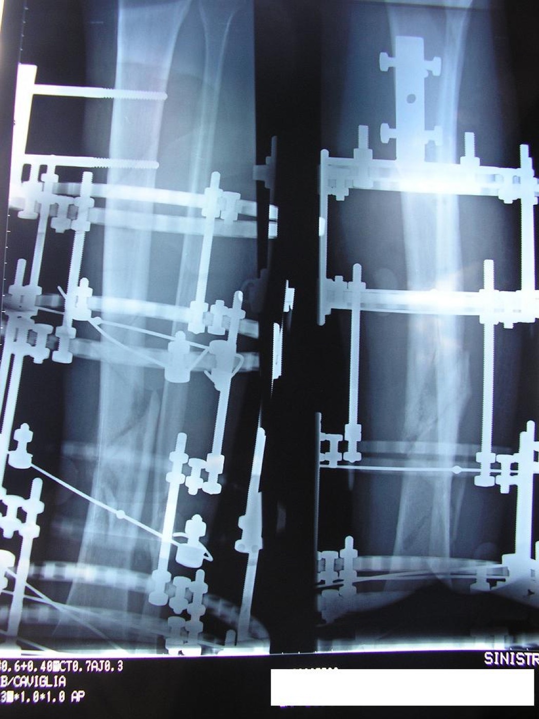 Figure 3. A tibia and fibula in an Ilizarov ring fixator, with callus forming three months on, the workhorse for non-union and bone transport. Source: Viapastrengo, via Wikimedia Commons, CC BY-SA 3.0.