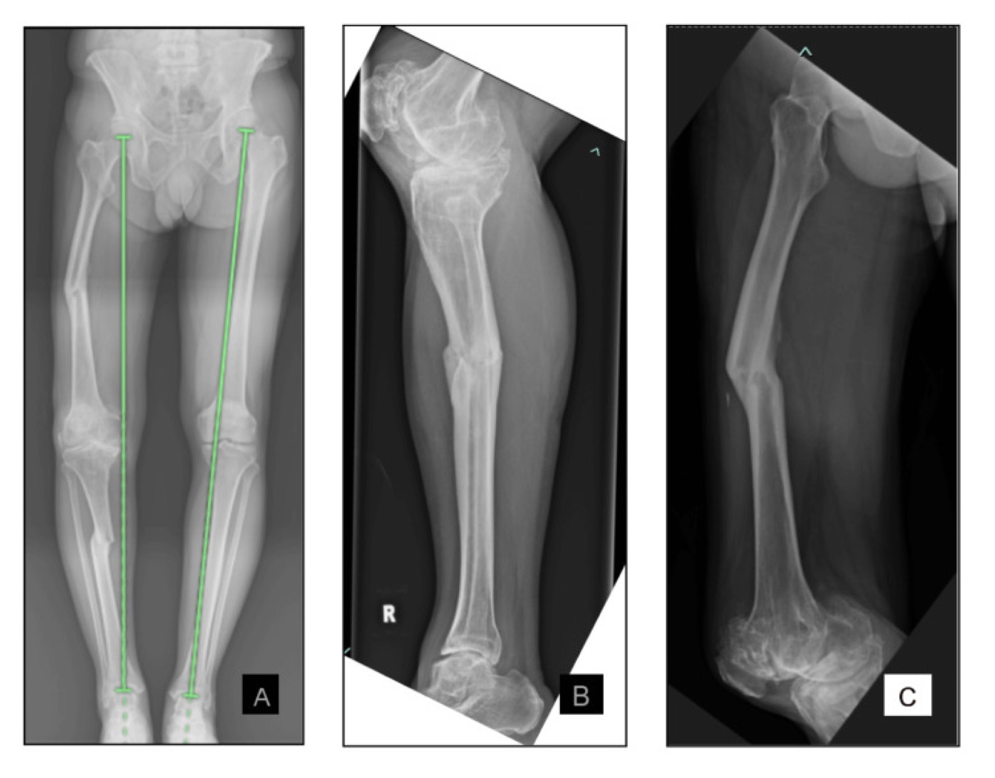 Figure 5. Malunion of a “floating-knee” injury: a standing scanogram with mechanical-axis lines (A) and the malunited tibia (B) and femur (C) with multiplanar angular deformity. From Matheen et al. (2024), Cureus, PMC11446639, CC BY 4.0.