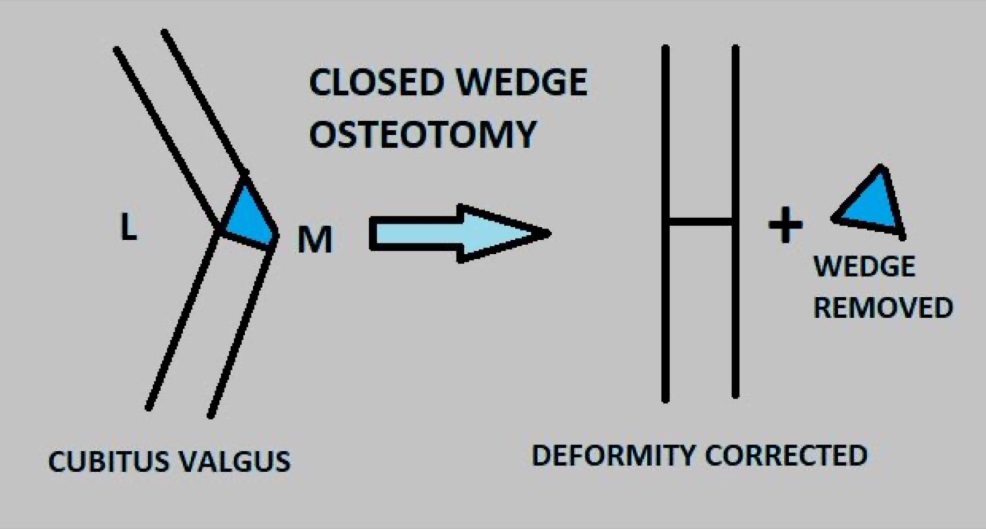 Figure 6. A closing-wedge corrective osteotomy: a bone wedge is removed to realign the deformity (here a cubitus valgus). Source: Dr. Vijayachandar, via Wikimedia Commons, CC BY-SA 4.0.
