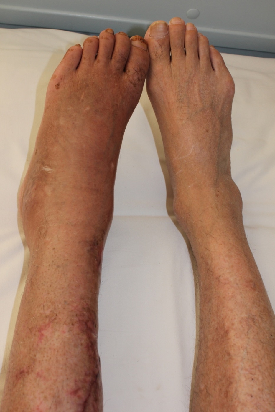 Figure 10. Type-I CRPS (Sudeck) of the left lower limb after a tibial fracture: swelling and colour change versus the normal side. Source: Timsong311, via Wikimedia Commons, CC BY-SA 3.0.
