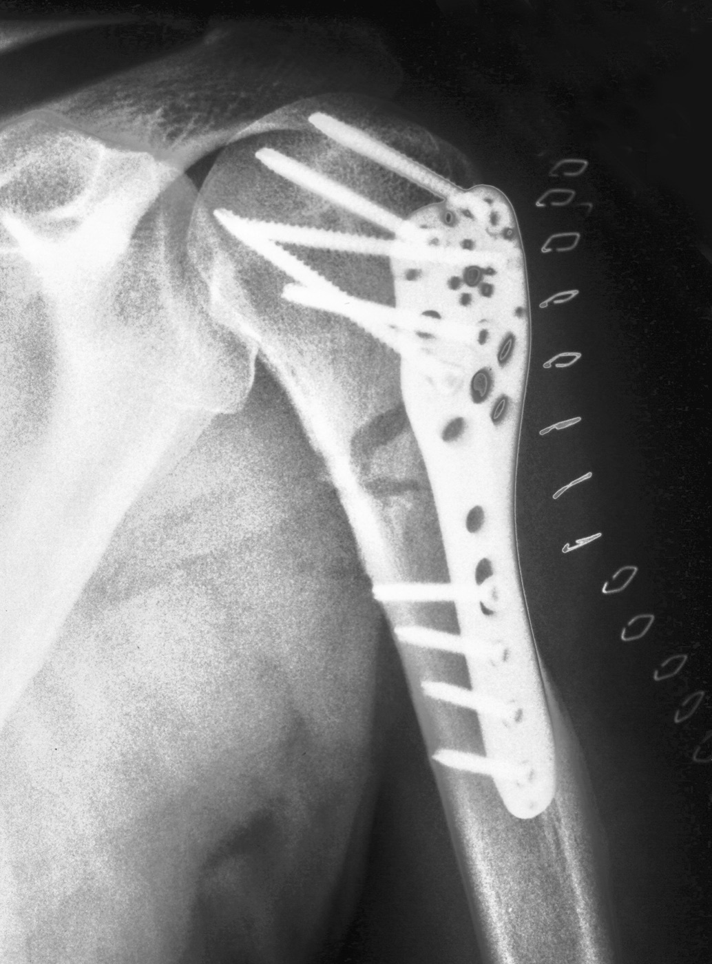 Figure 8. A proximal humeral fracture fixed with an angular-stable locking plate, the divergent locking screws anchoring the head fragment, the classic indication of poor bone stock in a short periarticular segment. Source: Thomas Zimmermann, via Wikimedia Commons, CC BY-SA 3.0 DE.