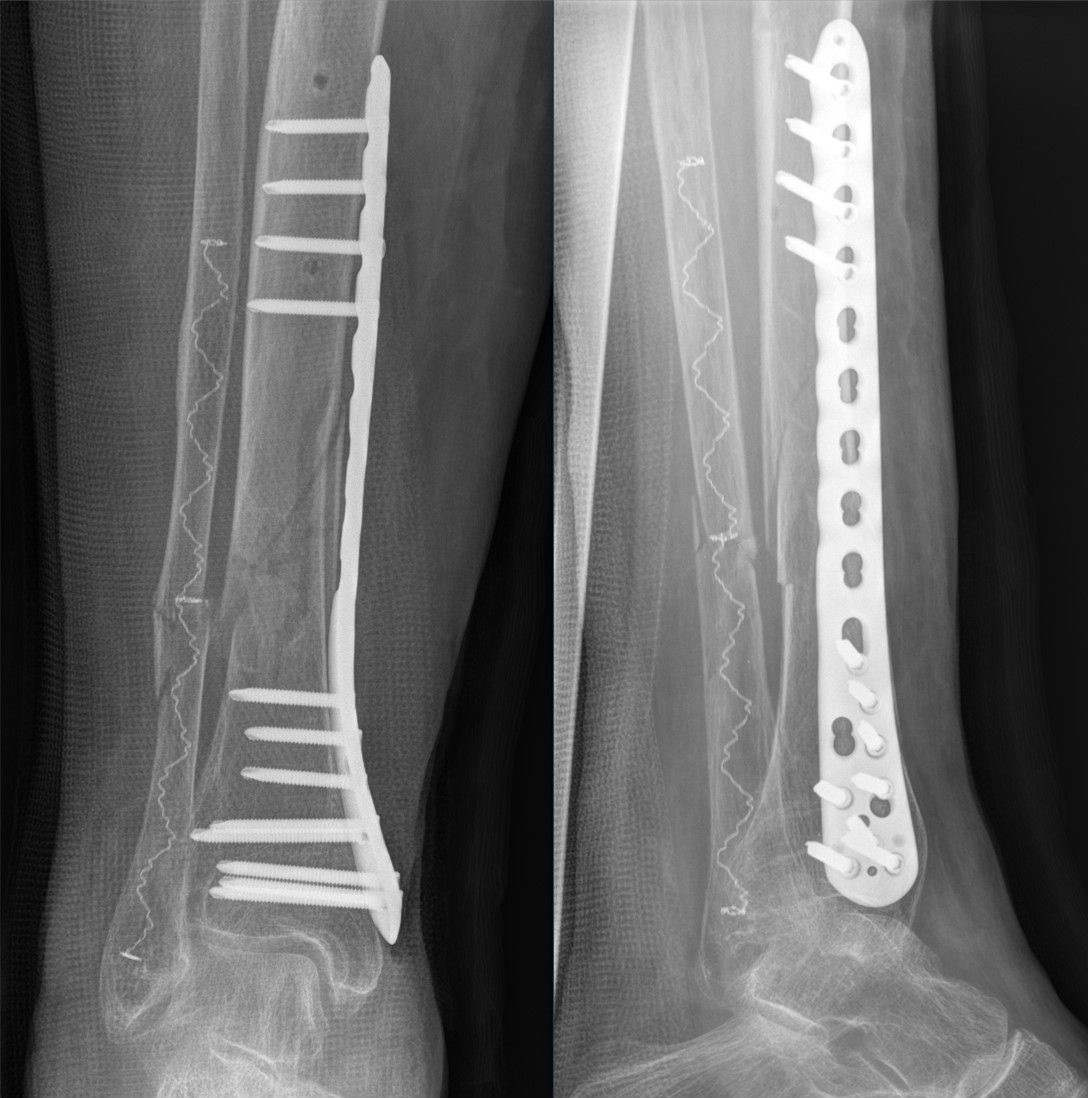 Figure 9. Bridge plating of a comminuted distal-tibia fracture: a long plate spans the fracture, fixed only at the ends with the holes over the comminuted zone left empty, giving relative stability and callus healing. Source: Hellerhoff, via Wikimedia Commons, CC BY-SA 4.0.