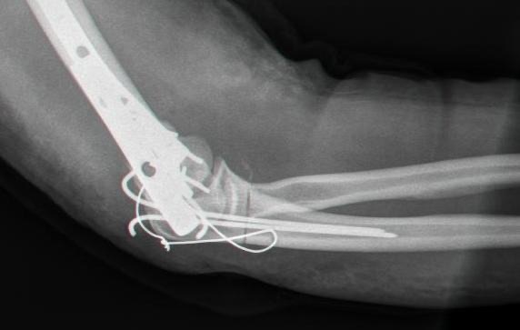 Figure 11. Olecranon tension-band wiring (two K-wires plus a figure-of-eight wire), converting the triceps pull into compression across the fracture. Source: Mehlauge, via Wikimedia Commons, Public Domain.