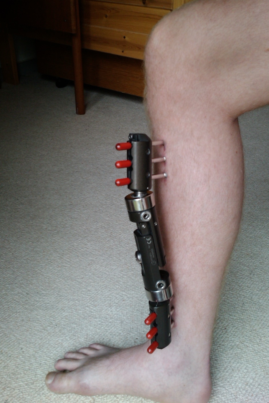 Figure 14. A tibia in a monolateral (uniplanar) external fixator: Schanz half-pins above and below the fracture connected to a single longitudinal bar. Source: Redhead.dk, via Wikimedia Commons, CC BY 3.0.