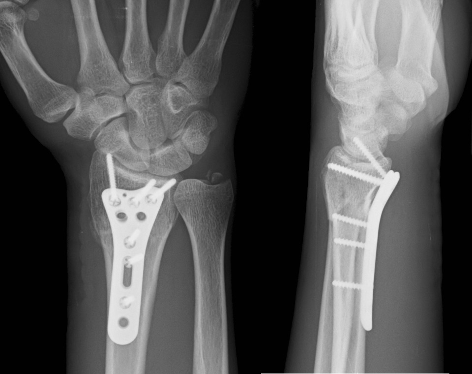 Figure 6. Distal radius fracture fixed with a volar plate and screws (PA and lateral views). Source: Pietz, via Wikimedia Commons, CC BY-SA 4.0.