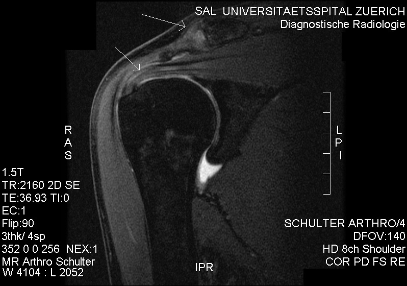 Figure 5. Coronal MR arthrogram of subacromial impingement with partial supraspinatus damage. Source: RSatUSZ, via Wikimedia Commons, CC BY-SA 3.0.