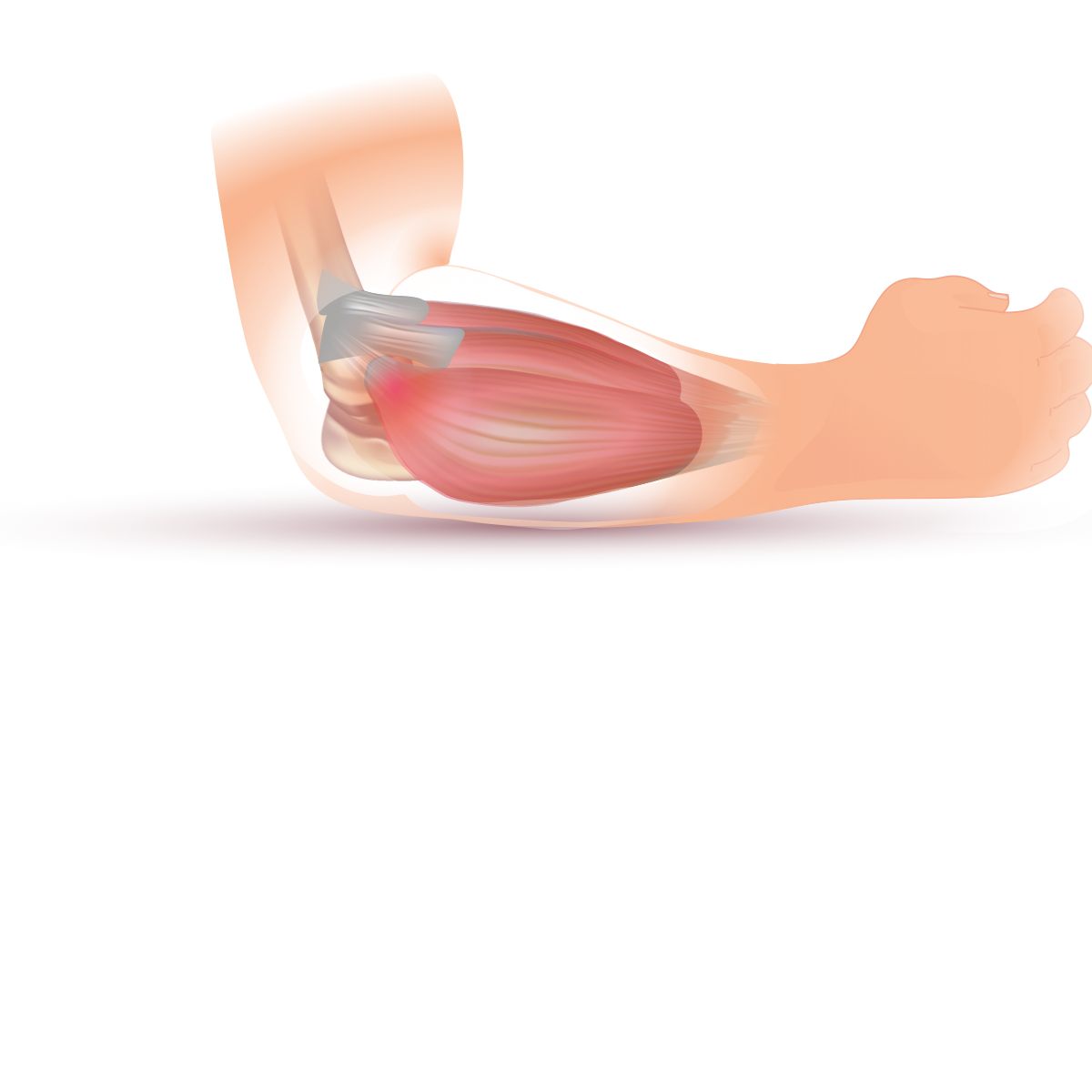 Figure 9. Lateral epicondylitis: the common extensor (ECRB) origin at the lateral epicondyle. Source: InjuryMap, via Wikimedia Commons, CC BY-SA 4.0.
