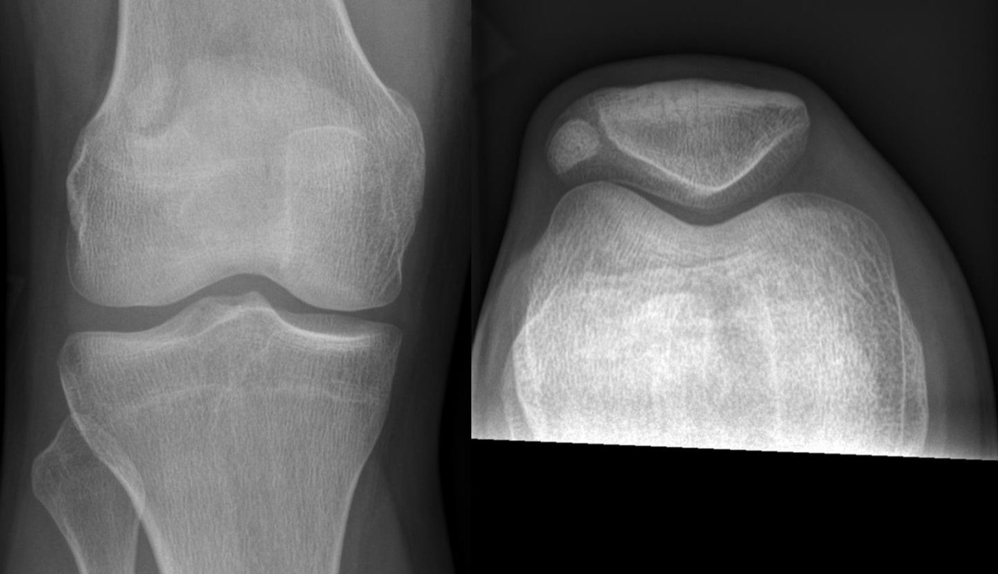 Figure 3. Bipartite patella: a superolateral accessory ossicle on AP and axial (skyline) views, a normal variant that mimics a fracture. Image by Hellerhoff, CC BY-SA 3.0, via Wikimedia Commons.