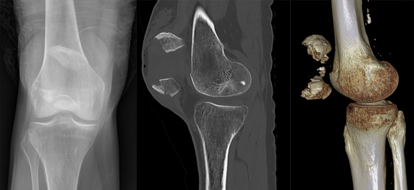 Figure 5. Comminuted patella fracture on AP radiograph, sagittal CT, and 3D volume rendering, with multiple displaced fragments. Image by Hellerhoff, CC BY-SA 4.0, via Wikimedia Commons.