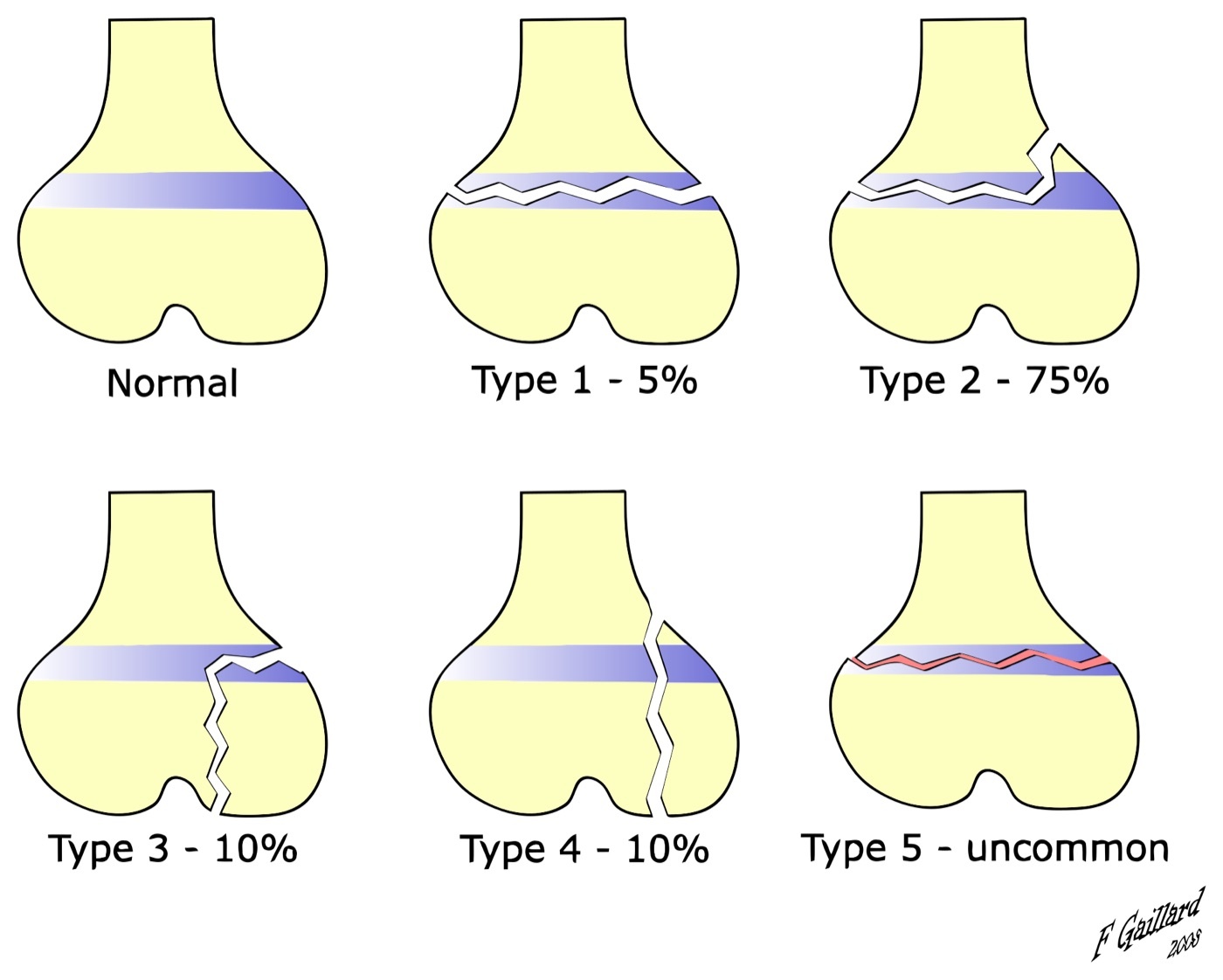 Figure 9. The Salter-Harris classification of physeal fractures (Types I-V) with their approximate frequencies. Dr Frank Gaillard, CC BY-SA 3.0, via Wikimedia Commons.