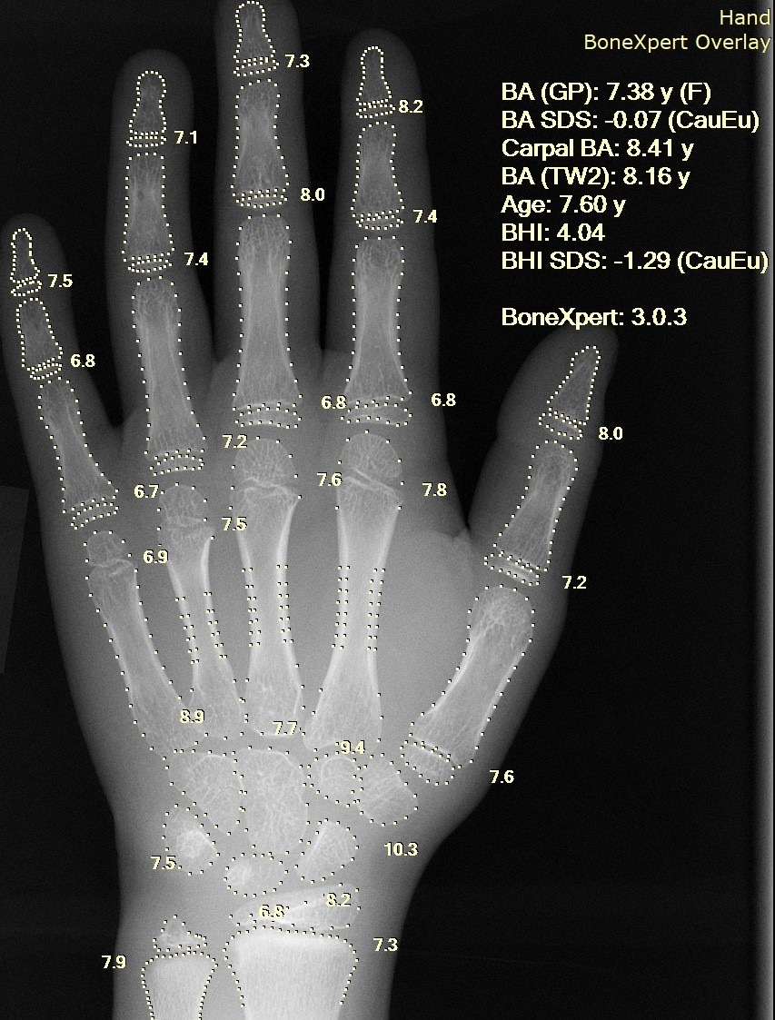 Figure 16. A pediatric hand radiograph showing open physes throughout, the reserve of remaining growth that gives the child the capacity to remodel a malunion. Setzner1337, CC0, via Wikimedia Commons.