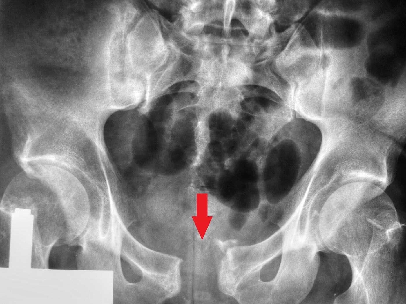 Figure 8. An open-book (anteroposterior-compression) injury: wide diastasis of the pubic symphysis (arrow). Nevit Dilmen, CC BY-SA 3.0, via Wikimedia Commons.