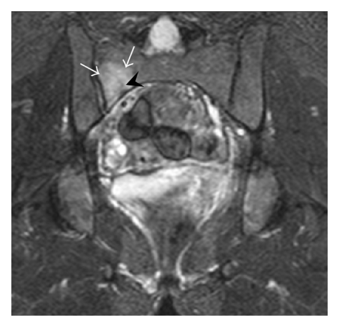 Figure 10. A right sacral alar fracture on coronal STIR MRI (arrows), with surrounding marrow oedema. Jarraya et al., CC BY 3.0, via Wikimedia Commons.