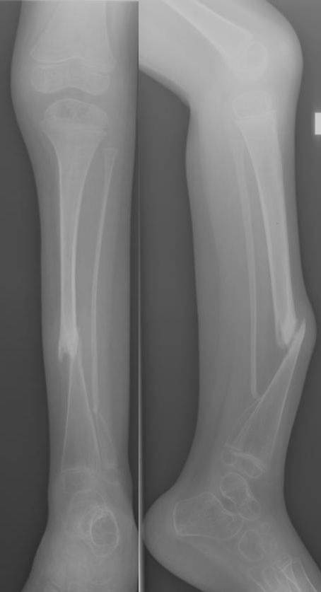 Antero-posterior and lateral radiographs of the lower leg in congenital pseudarthrosis of the tibia (neurofibromatosis-associated): anterolateral bowing with a dysplastic, tapered segment and pseudarthrosis at the middle/distal-third junction. (Kinderradiologie Olgahospital, Klinikum Stuttgart, Wikimedia Commons, CC BY-SA 3.0.)