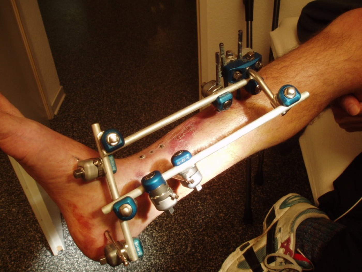 Figure 8. A joint-spanning external fixator: pins and rods giving relative stability while sparing the soft tissues, the mainstay of damage control. Source: via Wikimedia Commons, CC BY-SA 3.0.
