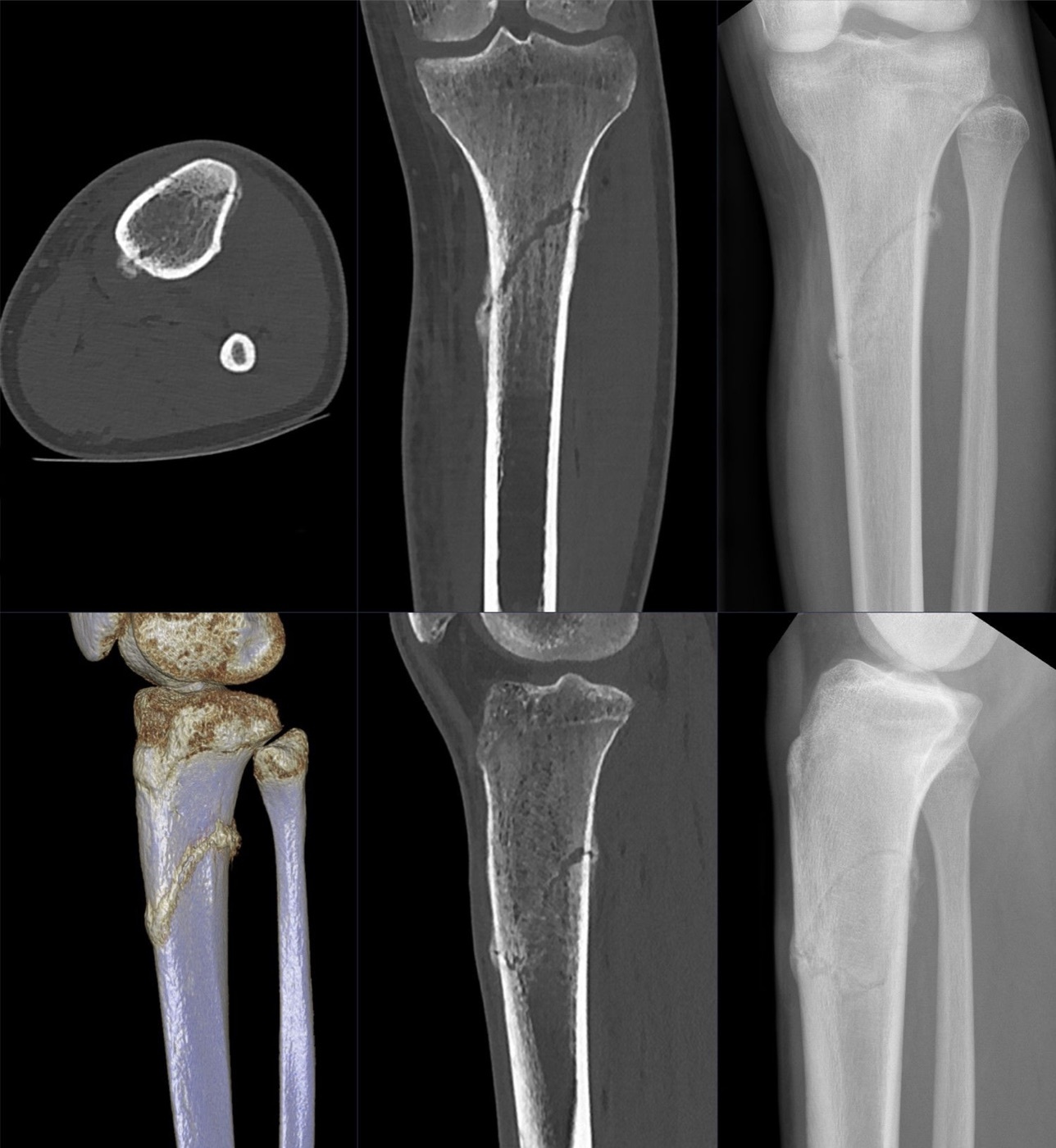 Figure 2. Abundant periosteal callus after a tibial shaft fracture, the radiographic hallmark of secondary healing under relative stability. Source: Hellerhoff, via Wikimedia Commons, CC BY-SA 4.0.