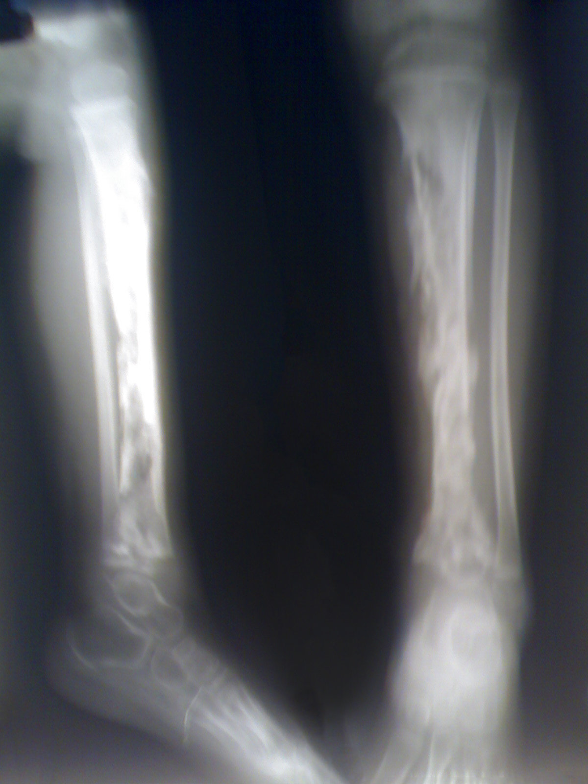 Figure 3. Acute osteomyelitis of the tibia in a child, with intraosseous abscess. sarindam7, CC BY-SA 4.0, Wikimedia Commons.