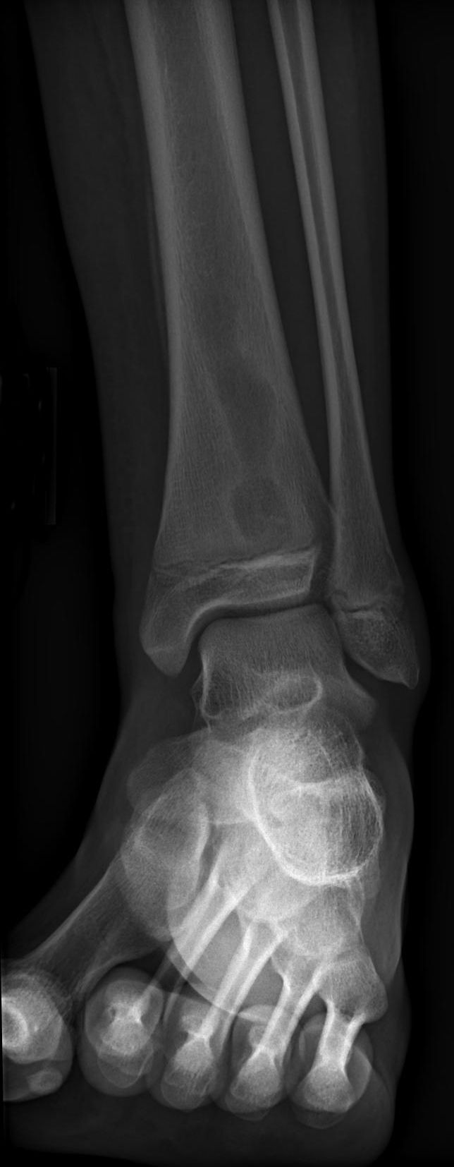 Figure 4. Brodie abscess - well-defined lytic lesion with a sclerotic rim, distal tibia. Jto410, CC BY-SA 3.0, Wikimedia Commons.