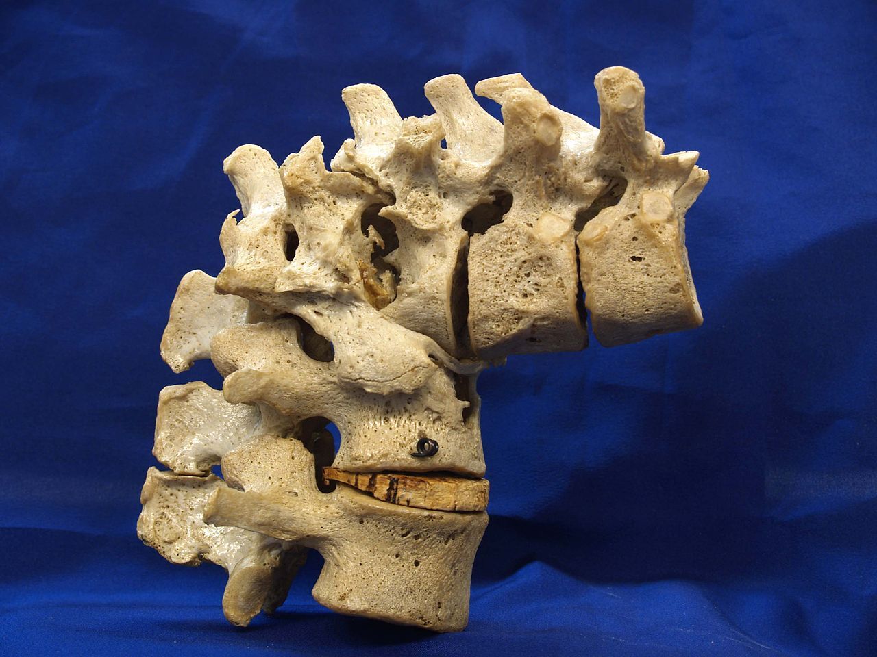 Figure 8. Pott disease - angular kyphosis (gibbus) from tuberculous vertebral collapse (dry specimen). Otis Historical Archives, NMHM, CC BY 2.0, via Wikimedia Commons.