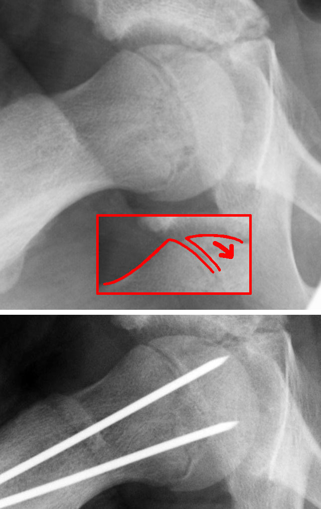 In-situ fixation. A slipped epiphysis (top, arrow) stabilised in situ with implants crossing the physis (bottom), without reduction. Dr. Jochen Lengerke, via Wikimedia Commons (public domain).