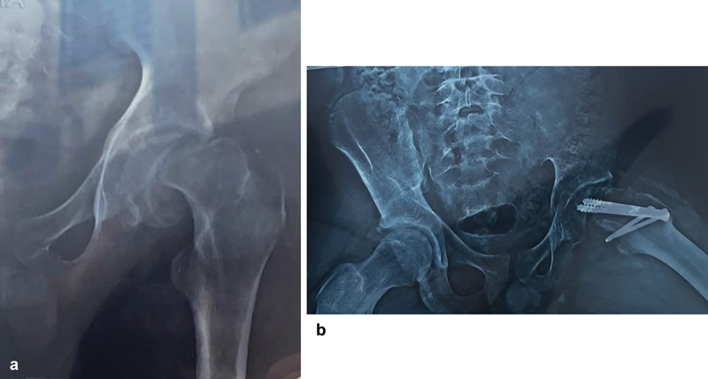 Avascular necrosis after SCFE. A severe slip (a) and the follow-up film after fixation (b) showing osteonecrosis of the femoral head - the dominant complication, far commoner after unstable slips. Bhuyan BK, Rev Bras Ortop 2024;59(6):e913-e921, Fig. 3 (CC BY 4.0).