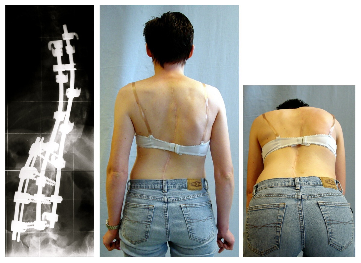 Posterior instrumented spinal fusion. Postoperative radiograph showing a dual-rod, segmental construct correcting an adolescent curve, with the clinical result and the healed midline incision. Weiss HR, Goodall D, Scoliosis 2008;3:9, via Wikimedia Commons (CC BY 2.0).