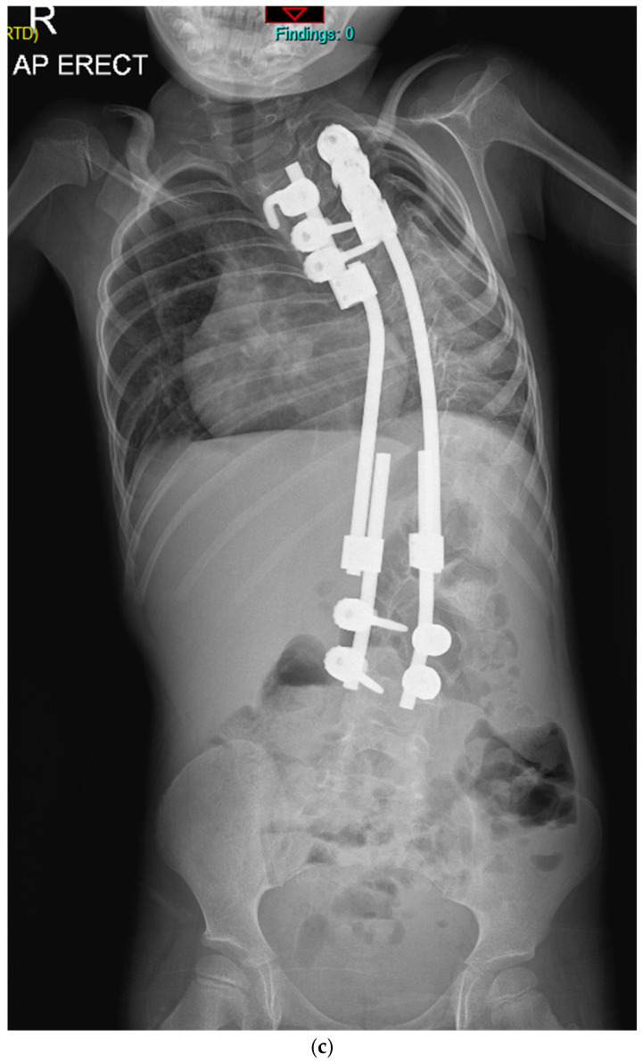 Growth-friendly surgery for early-onset scoliosis. Erect antero-posterior radiograph of a young child with a traditional growing-rod construct, which controls the curve while allowing the trunk and lungs to keep growing before any definitive fusion. Balasubramanian SG et al., J Clin Med 2026;15(2):754 (CC BY 4.0).
