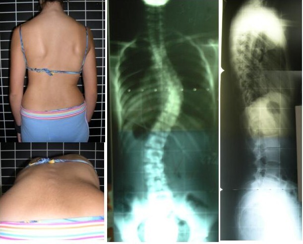 Clinical detection of scoliosis. A standing posterior photograph and the Adams forward-bend view (left) reveal the trunk asymmetry and rib hump, confirmed on antero-posterior and lateral radiographs (right). Rigo M, Negrini S, Weiss HR et al. (SOSORT), via Wikimedia Commons (CC BY 2.0).