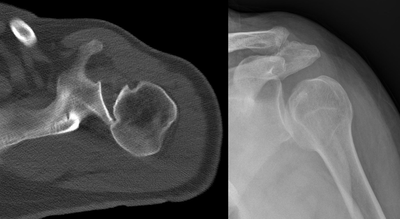 Figure 15. Reverse Hill-Sachs (McLaughlin) lesion: the anteromedial humeral-head impaction defect of a posterior dislocation, on axial CT (left) and radiograph (right). Source: Hellerhoff, via Wikimedia Commons, CC BY-SA 3.0.