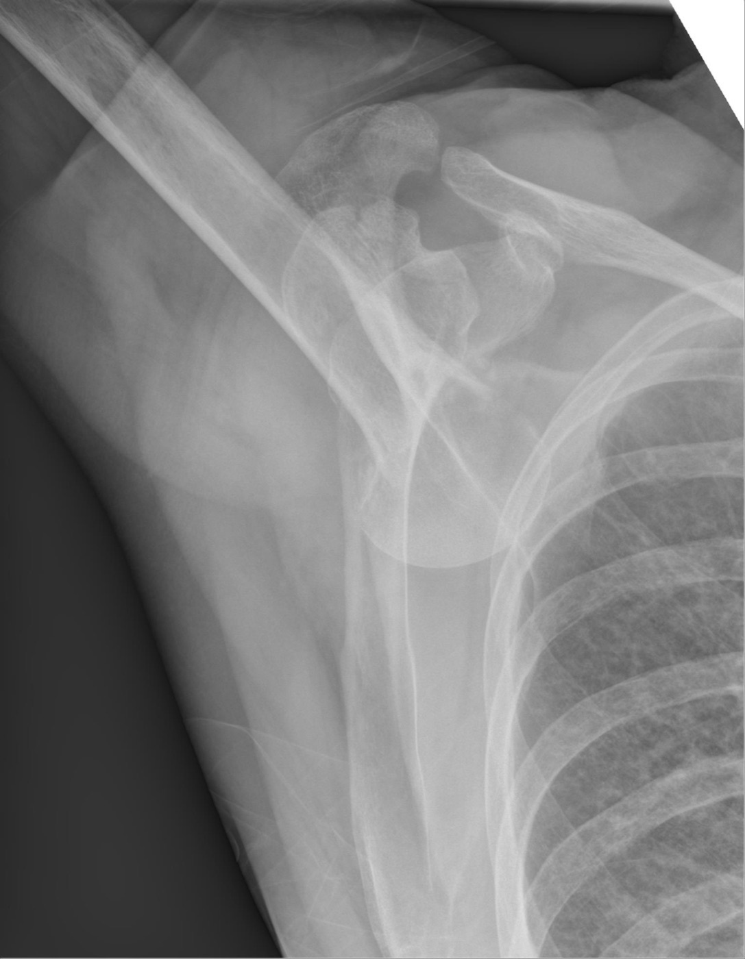 Figure 4. Luxatio erecta (inferior dislocation): the head sits below the glenoid with the arm fixed overhead. Source: Hellerhoff, via Wikimedia Commons, CC BY-SA 3.0.