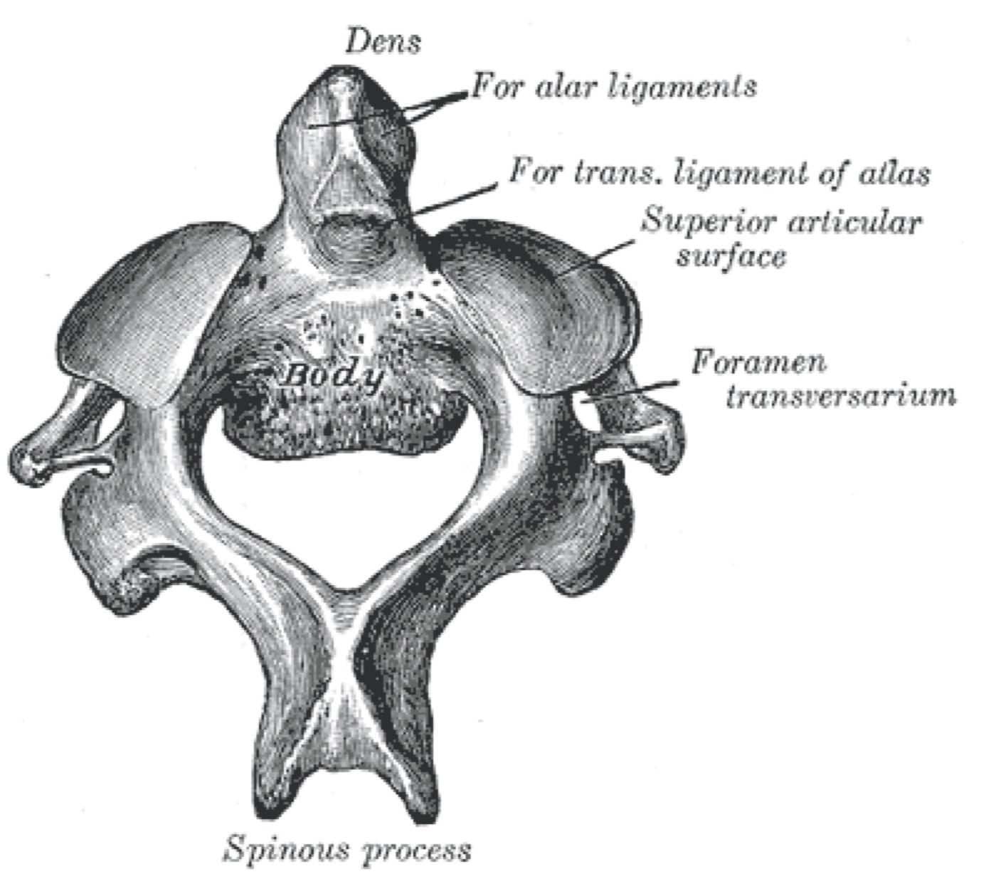 Figure 4. The axis (C2) from above, showing the odontoid process (dens) and the facets for the transverse and alar ligaments. The dens base is the site of the high-nonunion type II fracture. From Gray’s Anatomy (H. V. Carter, 1918), public domain, via Wikimedia Commons.