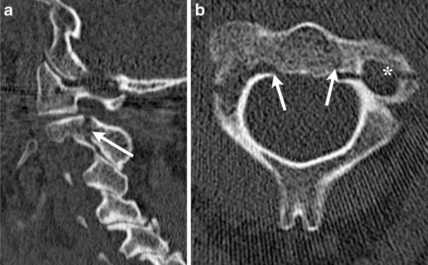 Figure 6. CT of a hangman’s fracture (traumatic spondylolisthesis of the axis): sagittal and axial images with arrows at the bilateral C2 pars fractures. From Utz et al. (2013), Insights into Imaging 5(1):67-75, CC BY 4.0, via Wikimedia Commons.