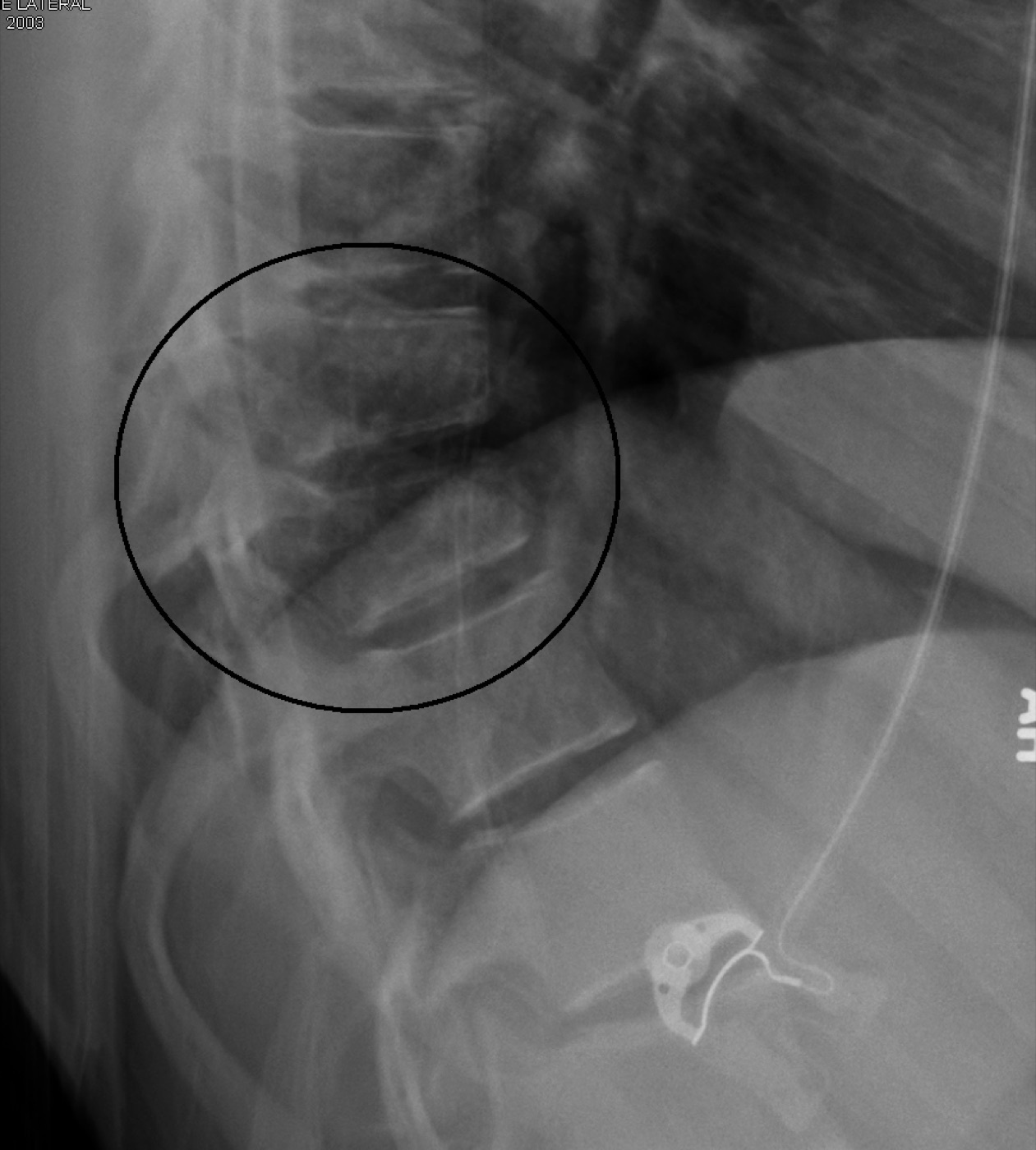 Figure 11. Lateral radiograph of a Chance (flexion-distraction / seat-belt) fracture (circled): a horizontal tension-band injury. The seat-belt sign mandates a search for abdominal injury. Source: James Heilman, MD, via Wikimedia Commons, CC BY-SA 3.0.
