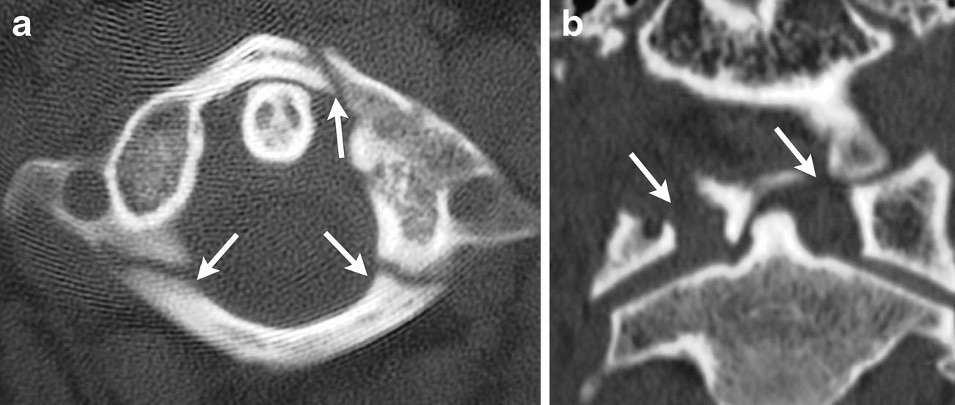 Figure 6. CT of a Jefferson (C1 burst) fracture: the axial image shows fractures of the anterior and posterior arches of the atlas, with lateral-mass spread on the coronal reformat. Utz et al., CC BY 4.0, via Wikimedia Commons.