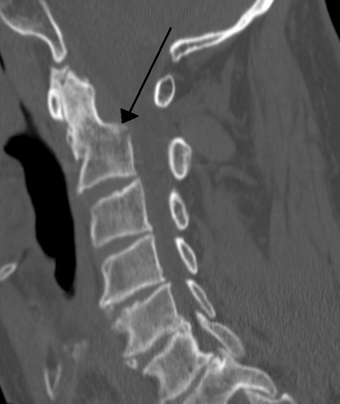 Figure 7. Sagittal CT showing a fracture through the base of the odontoid process (dens) of C2, the Anderson and D’Alonzo type II pattern that carries the highest nonunion risk. James Heilman, MD, CC BY-SA 3.0, via Wikimedia Commons.