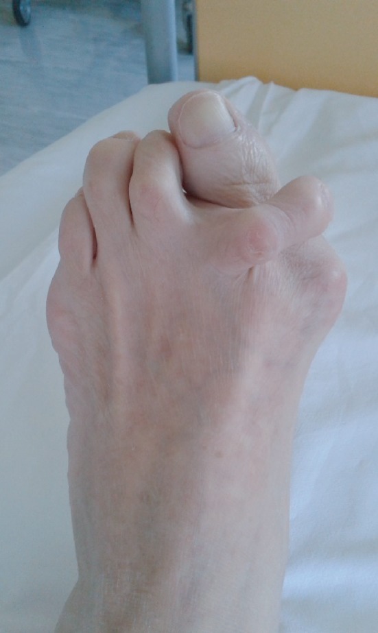 Crossover second toe. The second toe deviates dorsomedially and crosses over the great toe, here with an associated hallux valgus. Case Rep Orthop 2020;2020:3901458, Fig. 1 (CC BY 4.0).