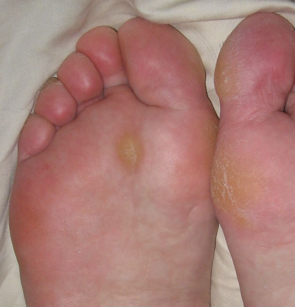 Plantar keratosis. A discrete callus over the central sub-metatarsal region of the sole. Jmarchn, Wikimedia Commons, CC BY-SA 3.0.
