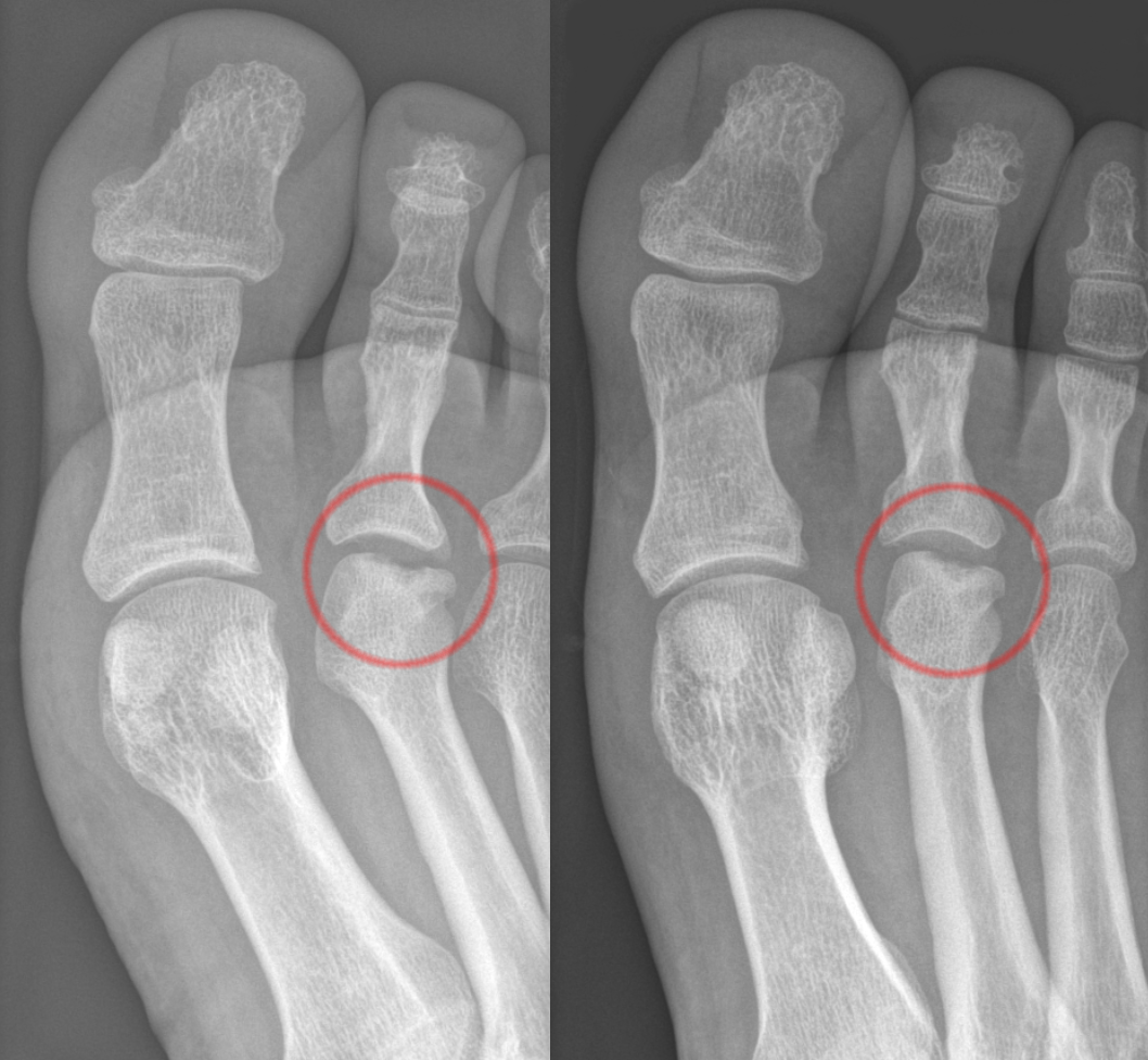 Freiberg infraction. AP radiograph with the second metatarsal head circled, showing flattening and sclerosis (osteonecrosis). Hellerhoff, Wikimedia Commons, CC BY-SA 3.0.