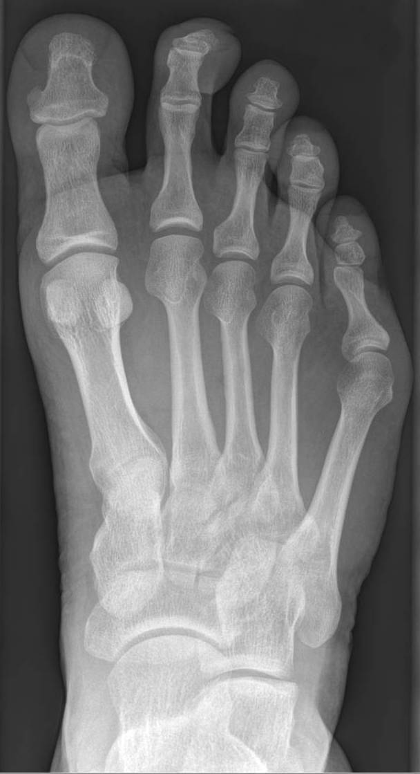 Bunionette (tailor’s bunion). AP radiograph showing a laterally prominent fifth metatarsal head with an increased fourth-fifth intermetatarsal angle. Hellerhoff, Wikimedia Commons, CC BY-SA 4.0.